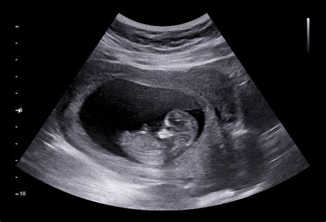 10 weeks dating ultrasound